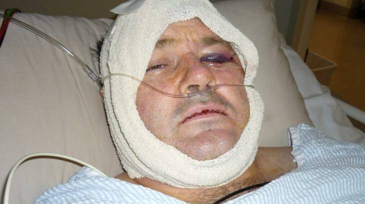 Broken Hill Prison Officer Jason Gould after he was hit by the billiard ball. Photo: Supplied